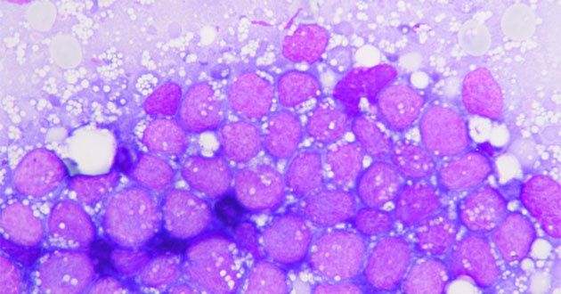 wpid-25925_mieloma.jpg