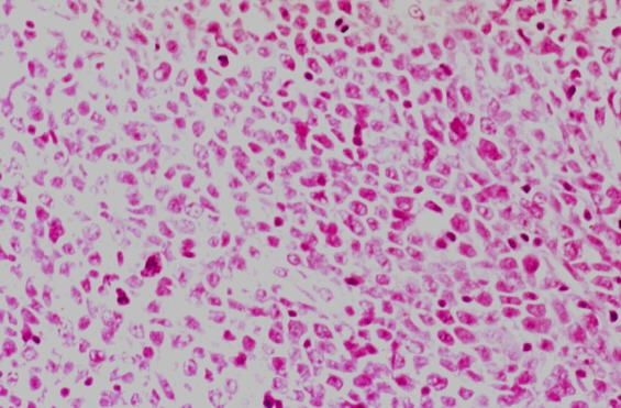 wpid-25959_tumorelinfoma.jpg