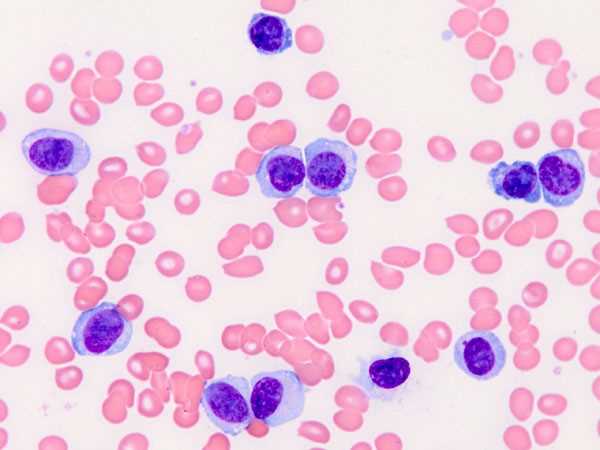 plasma_cell_leukemia